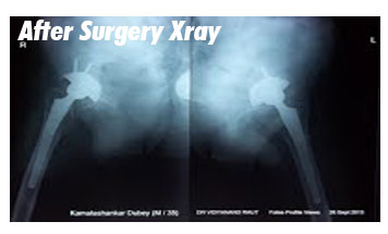After Surgery Xray