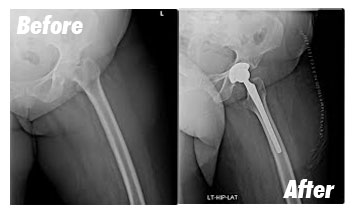 Case-5-Before-After-Xray